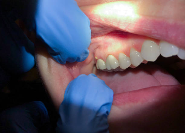 Best Emergency Gum Treatment in Hickman, NE